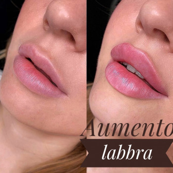 Збільшення губ. Косметологія
                    Тату мастер Анна Коломыя