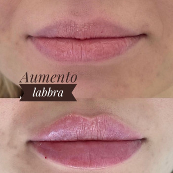 Збільшення губ. Косметологія
                    Тату мастер Анна Коломыя