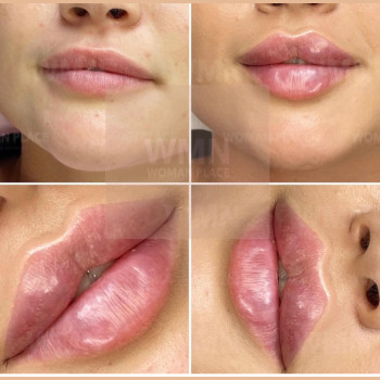Збільшення губ. Косметологія
                    Тату мастер Анна Коломыя