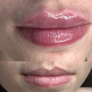 Збільшення губ. Косметологія
                    Тату мастер Анна Коломыя