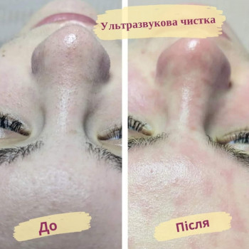 Ультразвукова чистка обличчя
                    Салон краси Flower lady Черкаси