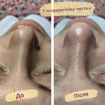 Ультразвукова чистка обличчя
                    Салон краси Flower lady Черкаси
