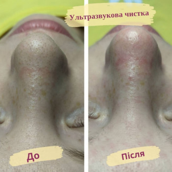 Ультразвукова чистка обличчя
                    Салон краси Flower lady Черкаси