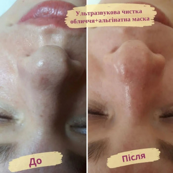 Ультразвукова чистка обличчя
                    Салон краси Flower lady Черкаси