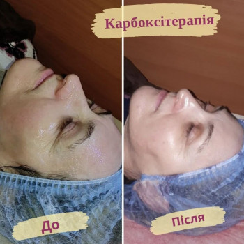 Карбоксітерапія
                    Салон красоты Flower lady Черкассы
