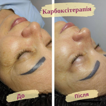 Карбоксітерапія
                    Салон красоты Flower lady Черкассы