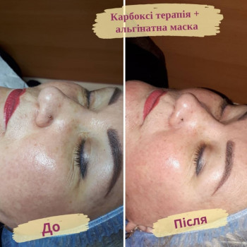 Карбоксітерапія
                    Салон красоты Flower lady Черкассы