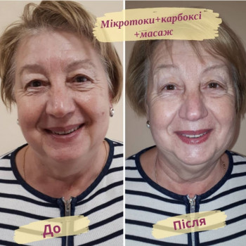 Карбоксітерапія
                    Салон красоты Flower lady Черкассы