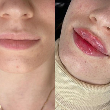 Увеличение губ