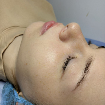 Гідропілінг
                    Салон краси Flower lady Черкаси