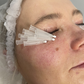 Нитьовий ліфтінг Мезониті 3D Ліфтінг
                    Косметолог-инъекционист Ольга Киев