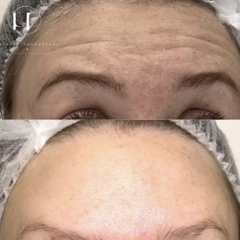 Ботулотоксин