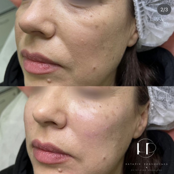 Середня третина обличчя