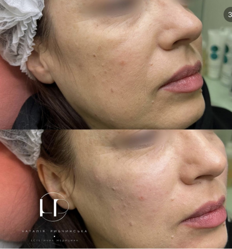 Біорепарація, фото - Лікар-косметолог Наталія Рибчинська