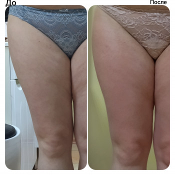 Антицеллюлитный массаж