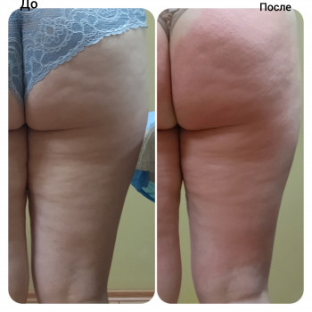 Антицеллюлитный массаж