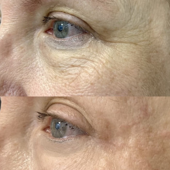 Заполнение морщин
                    Косметолог-ін'єкціоніст Наталья Одеса