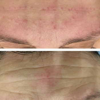 Заполнение морщин
                    Косметолог-ін'єкціоніст Наталья Одеса