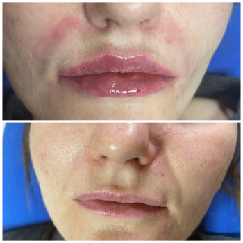 Заполнение морщин
                    Косметолог-ін'єкціоніст Наталья Одеса