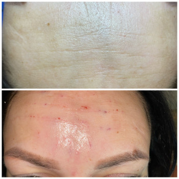 Заполнение морщин
                    Косметолог-ін'єкціоніст Наталья Одеса