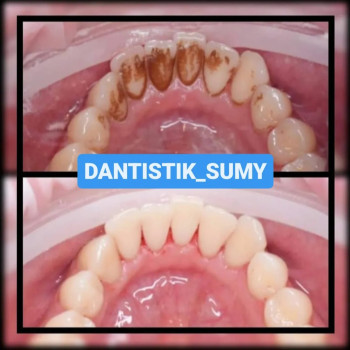 Дитячий стоматолог Сумы 
ПРОФЕСІЙНА ЧИСТКА ЗУБІВ