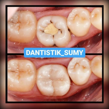 Дитячий стоматолог Сумы 
ЛІКУВАННЯ ЗУБІВ