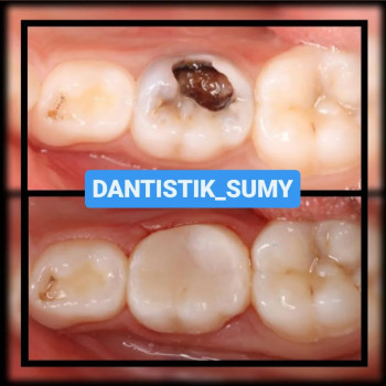 Дитячий стоматолог Сумы 
ЛІКУВАННЯ ЗУБІВ