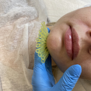 Підтяжка «другого підборіддя»