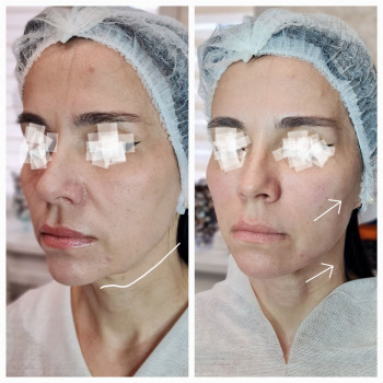 Векторний ліфтинг
Відновлення втрачених об'ємів