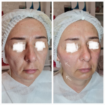 Радієс векторний ліфтинг