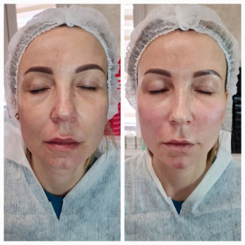 Радієс - Векторний ліфтинг обличчя 
Відновлення втрачених об