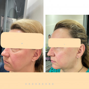 Фото из портфолио косметолога Зинаида Шуллер (Ужгород)