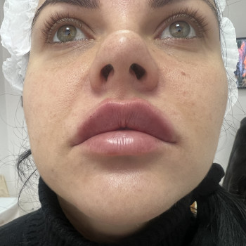 Одразу після процедури