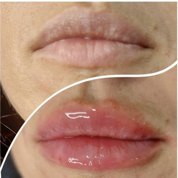 Збільшення губ