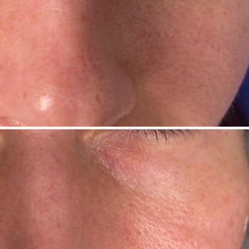 Корекція носослізноі борозни