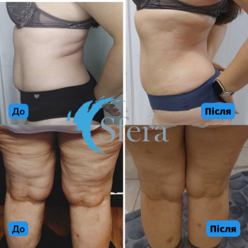 Масаж Starvak всього тіла
                    Косметологічний центр Сфера Плюс Київ