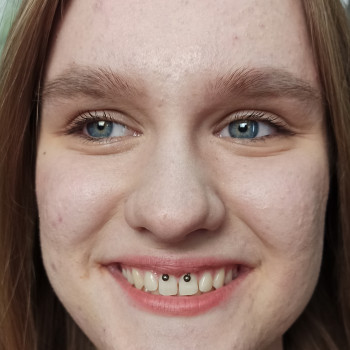 Пірсинг смайл (smile)
                    Мастер по пирсингу Сергій Киев