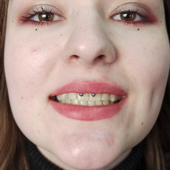 Пірсинг смайл (smile)
                    Мастер по пирсингу Сергій Киев