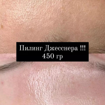 Пилинг Джесснера для пористой ,с неровным цветом кожи!