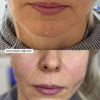 нитковий ліфтинг