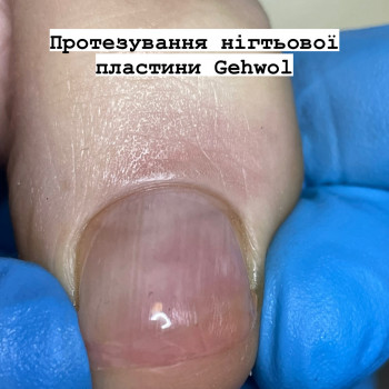 Протезування