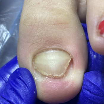 Зачистка оніхолізису