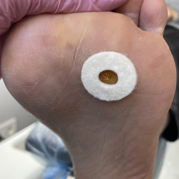 Обробка бородавки