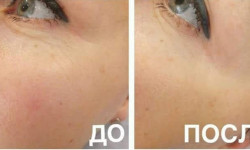 Чистка обличчя( комбінована ,УЗ,атравматична,кришталева,ферментна) Косметолог Елена Киев