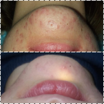 Чистка обличчя( комбінована ,УЗ,атравматична,кришталева,ферментна)
                    Косметолог Елена Киев