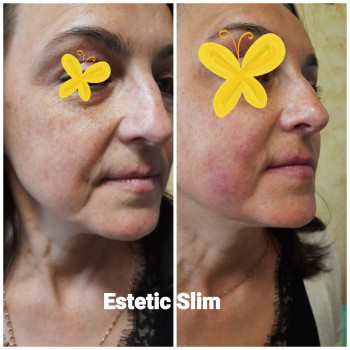  
 
До и сразу после процедуры