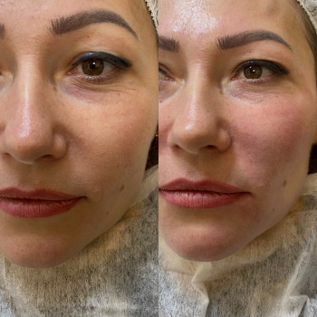 Нитковий ліфтинг. Корекція носогубного залому