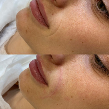 Заповнення філером носогубного залому