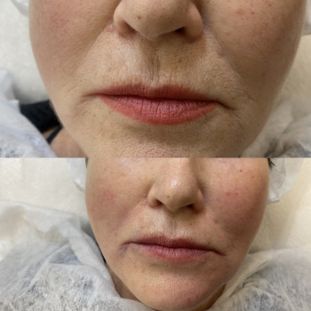 Нитковий ліфтинг носогубної складки