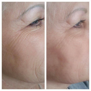 Електропорація
                    Косметологический центр Doskonala Ужгород